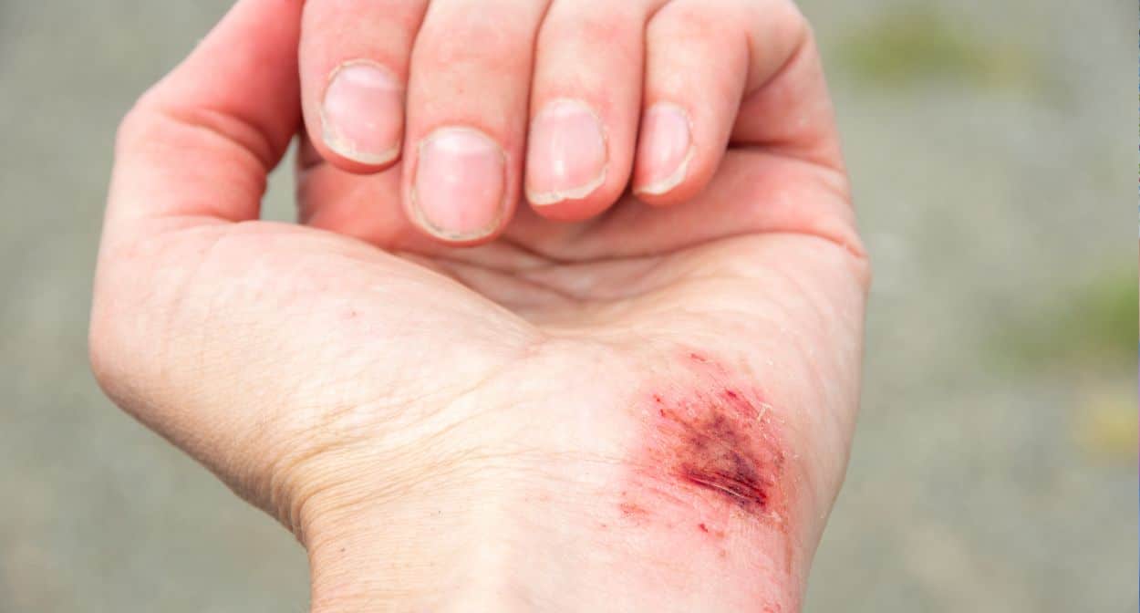 Types of Open Wounds