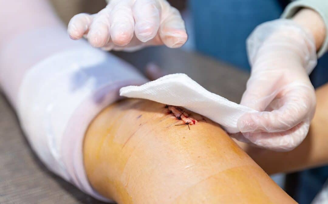 Understanding Different Types of Wounds